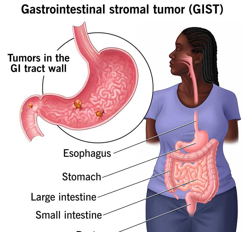 تومور استرومایی گوارشی (Gastrointestinal stromal tumor)
