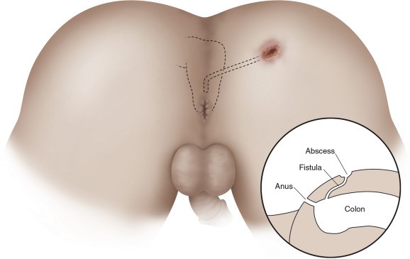 درمان فیستول مقعد