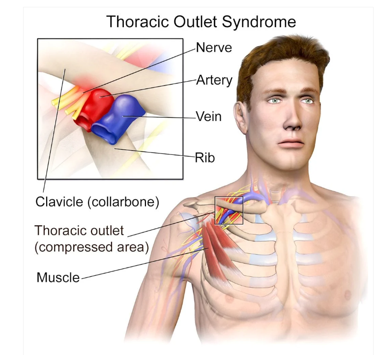 دنده گردنی (Cervical rib)