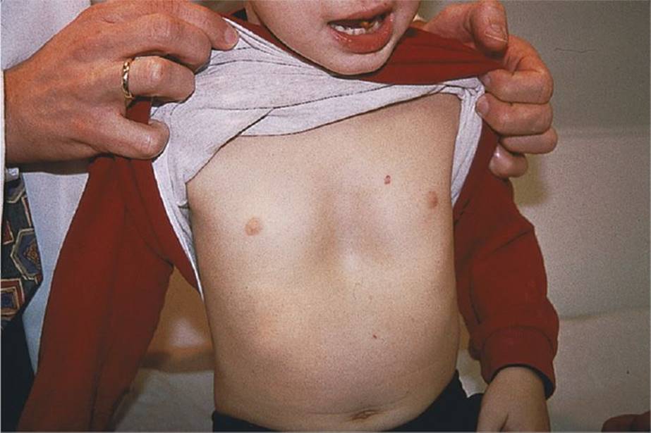 ناهنجاری های دیواره قفسه سینه