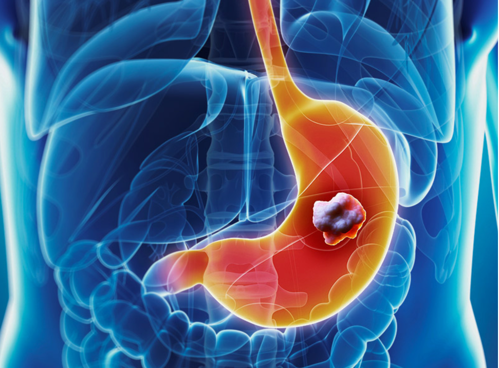 لنفوم معده (Gastric Lymphoma): علائم، درمان و پیش آگهی