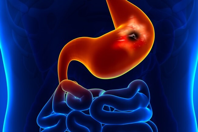 چه غذاهایی علائم زخم معده را بدتر یا بهتر میکند؟