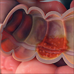 چه عواملی منجر به بیماری کولیت اولسراتیو میشود؟