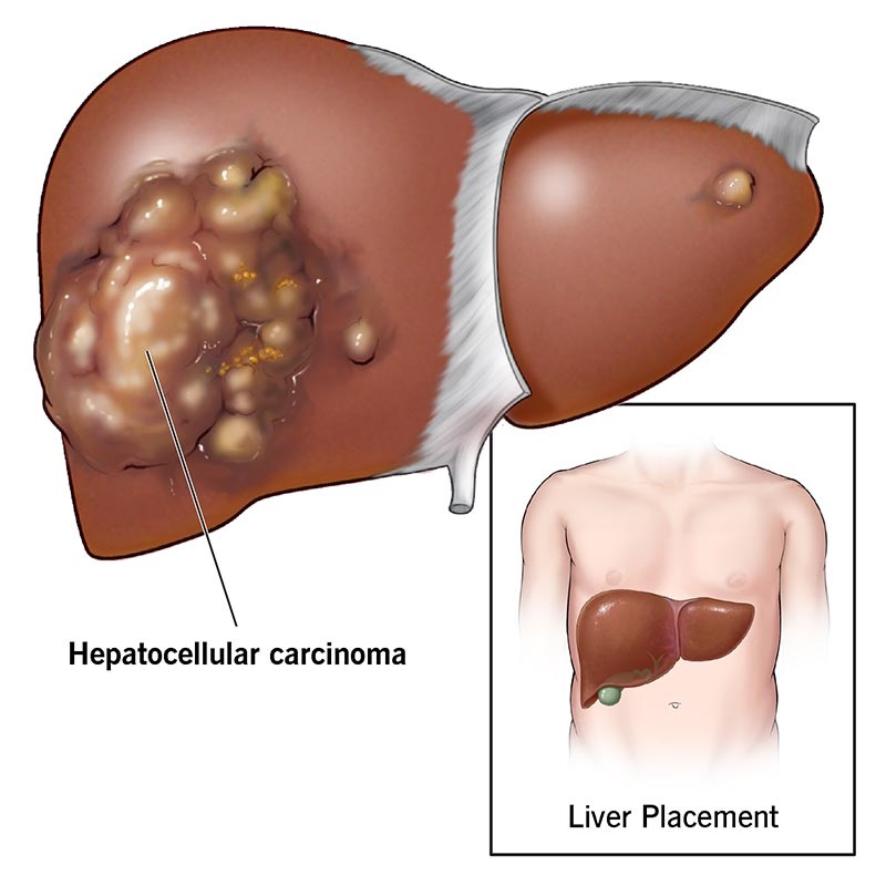 هپاتوسلولار کارسینوما (Hepatocellular-carcinoma)
