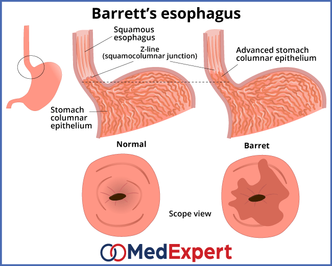مری بارت (Barrett's Esophagus)