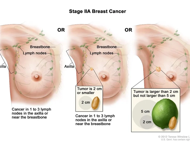 تعیین مرحله سرطان پستان