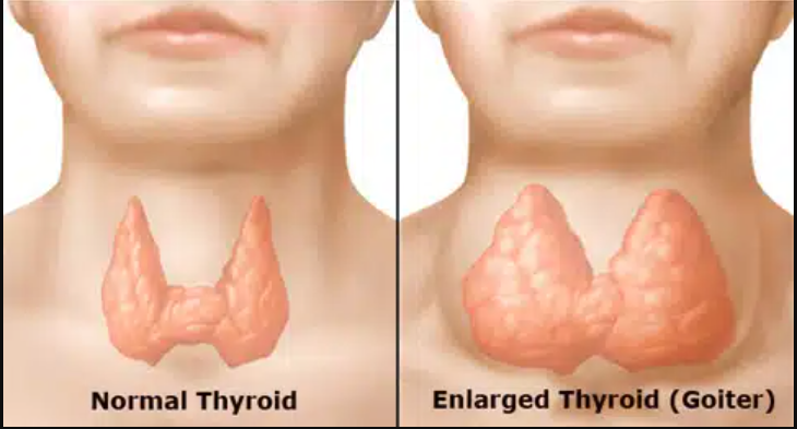 سوالات متداول در مورد بیماری گواتر (Goiter)