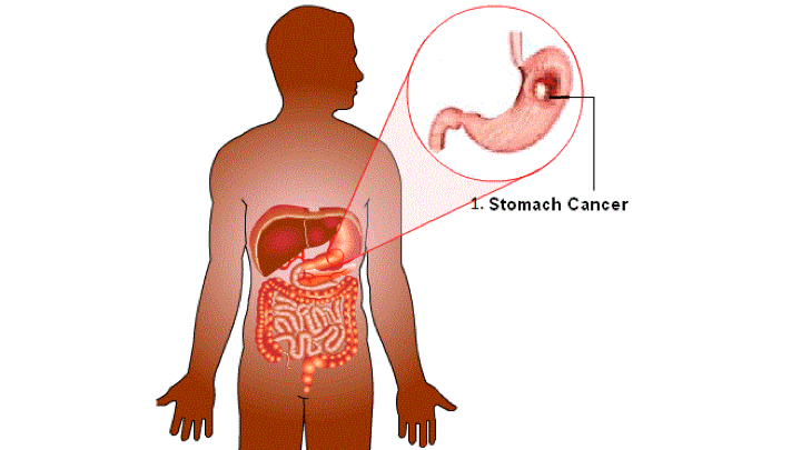 ارتباط بین زخم معده و سرطان معده