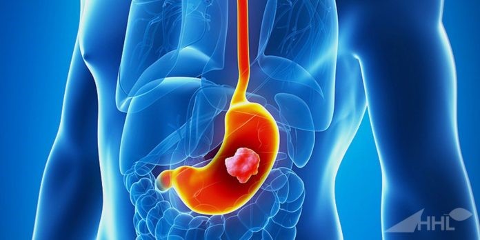 تعیین مرحله و پیشروی سرطان معده