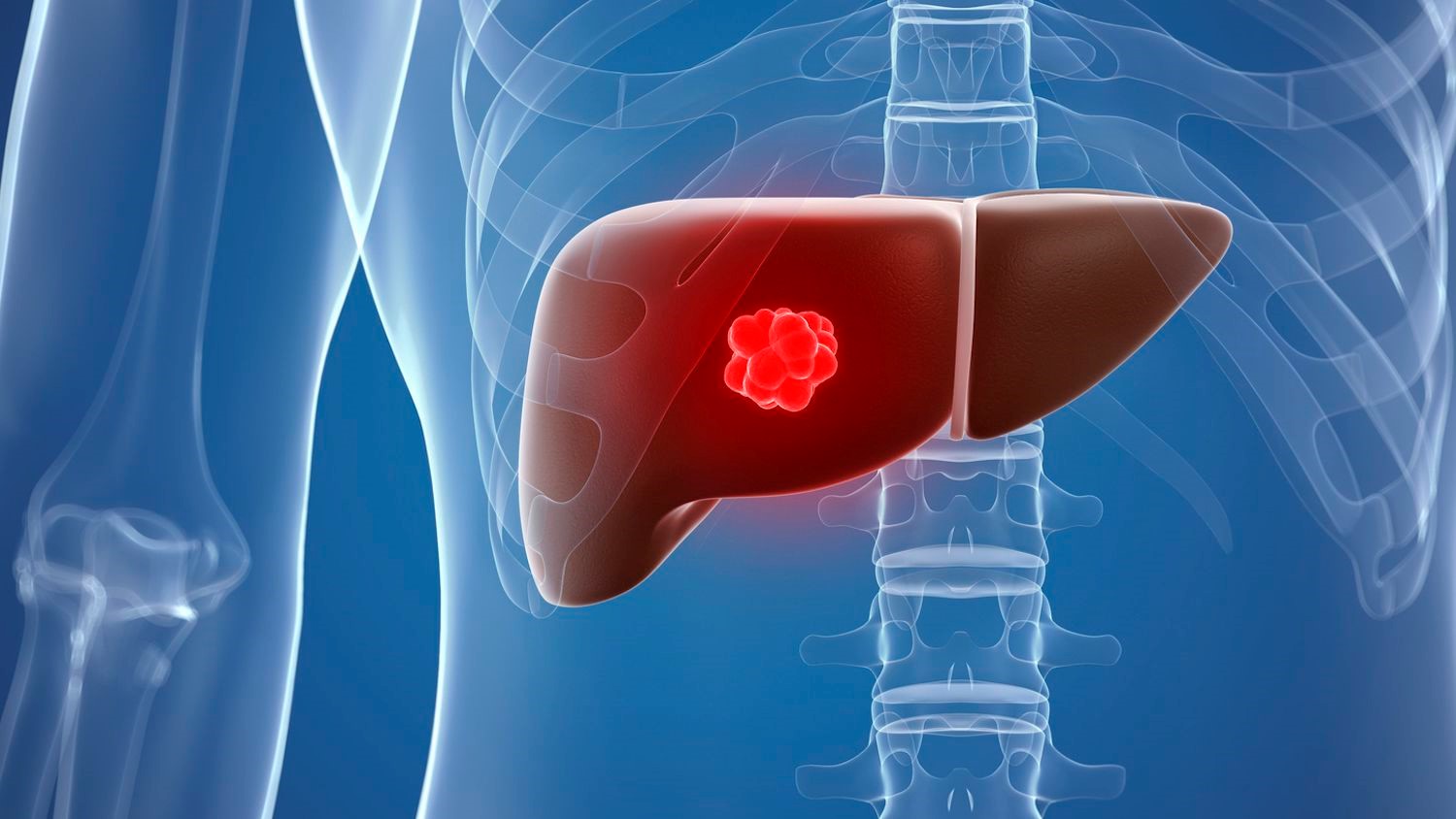 گسترش سرطان به کبد یا متاستاز کبدی