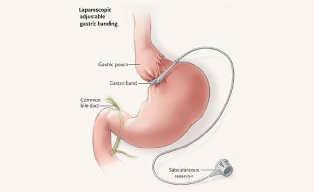 انواع جراحی های معده برای کاهش وزن