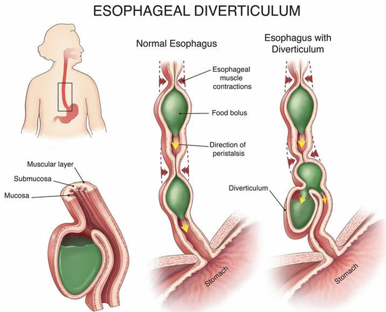 دیورتیکول مری (Esophageal Diverticulum)