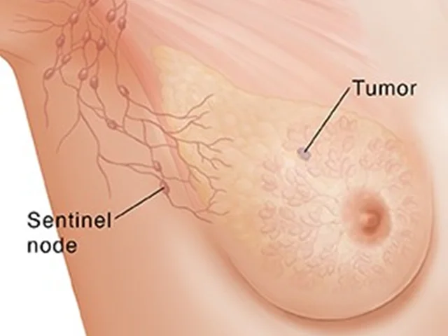نمونه برداری غده لنفاوی زیر بغل در سرطان پستان