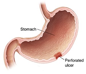 سوراخ شدن معده در اثر زخم معده