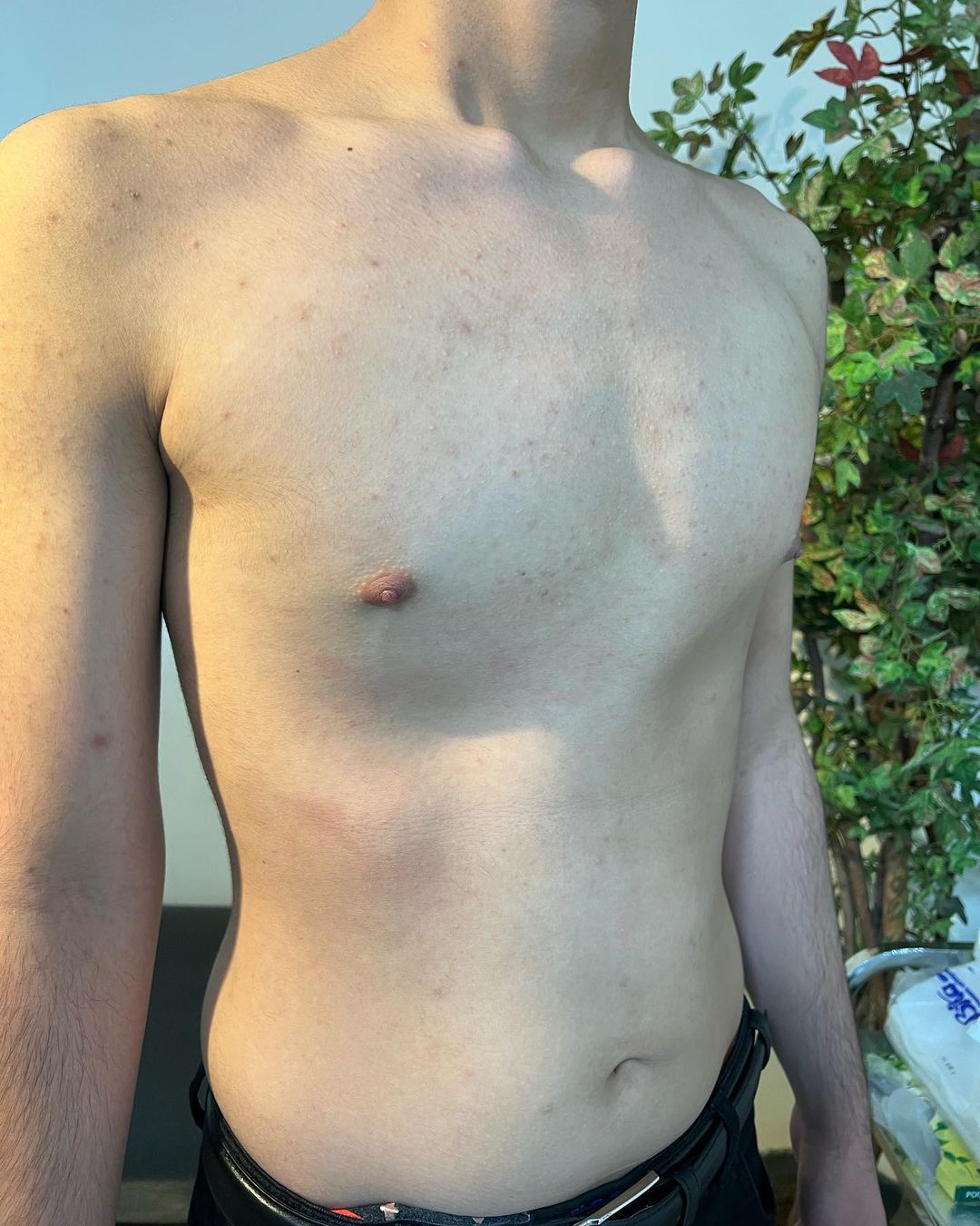 سوالات متداول در مورد پکتوس کاریناتوم (Pectus carinatum) یا سینه کبوتری