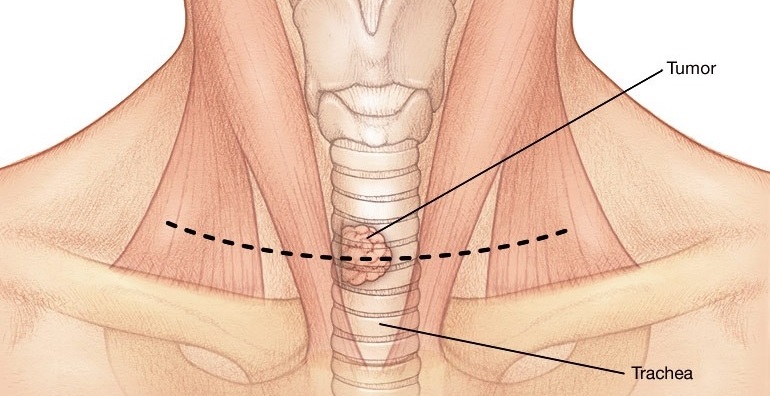 تومور های تراشه (Trachea Tumors)
