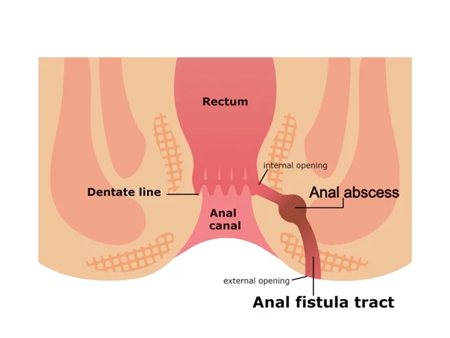 فیستولوتومی: عمل جراحی درمان فیستول مقعد چگونه است؟