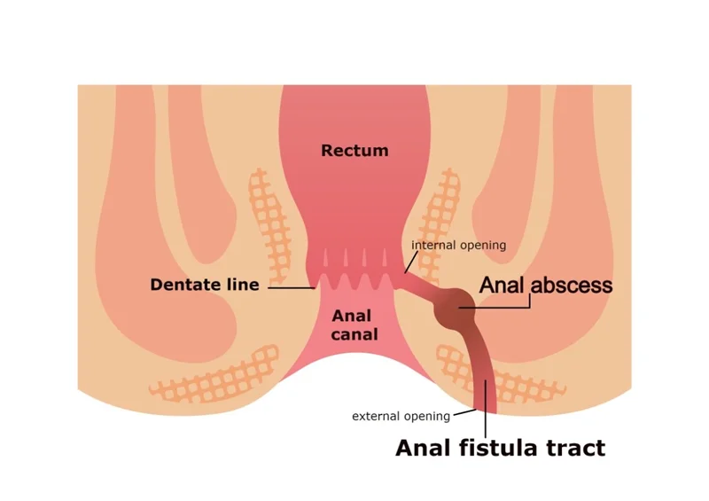 فیستولوتومی: عمل جراحی درمان فیستول مقعد چگونه است؟