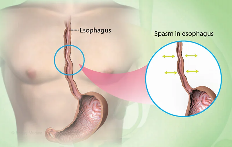 اسپاسم مری (Esophageal Spasms) چیست و چطور درمان می شود؟
