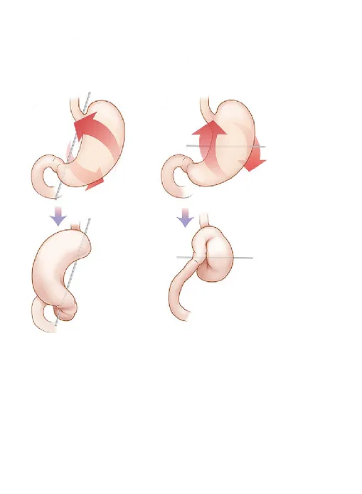 ولولوس معده (Gastric Volvulus)