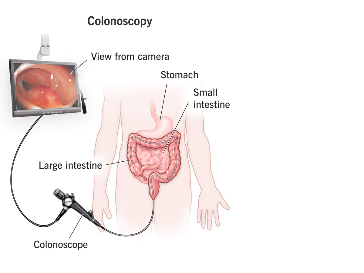 کلونوسکوپی روده برای تشخیص چه بیماری هایی است؟