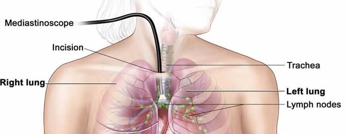 مدیاستینوسکوپی (Mediastinoscopy) چیست؟