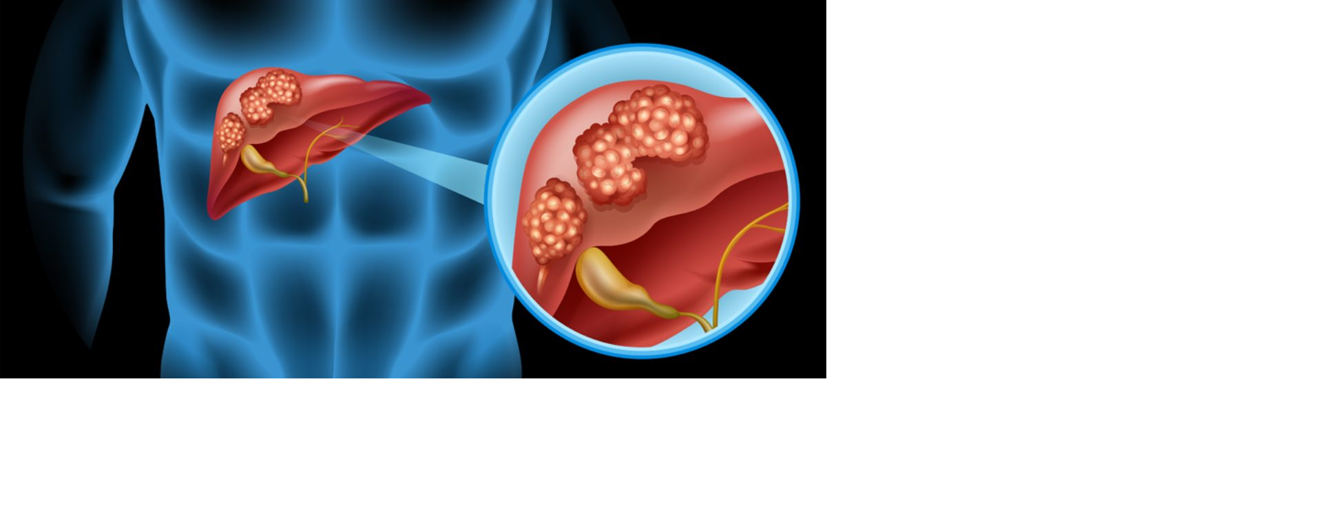 سرطان کبد و انواع آن