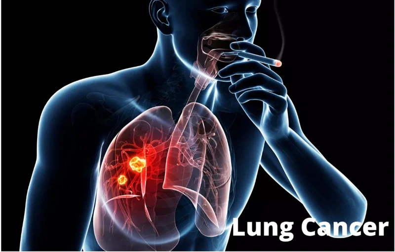 سوالات متداول در مورد سرطان ریه (Lung cancer)
