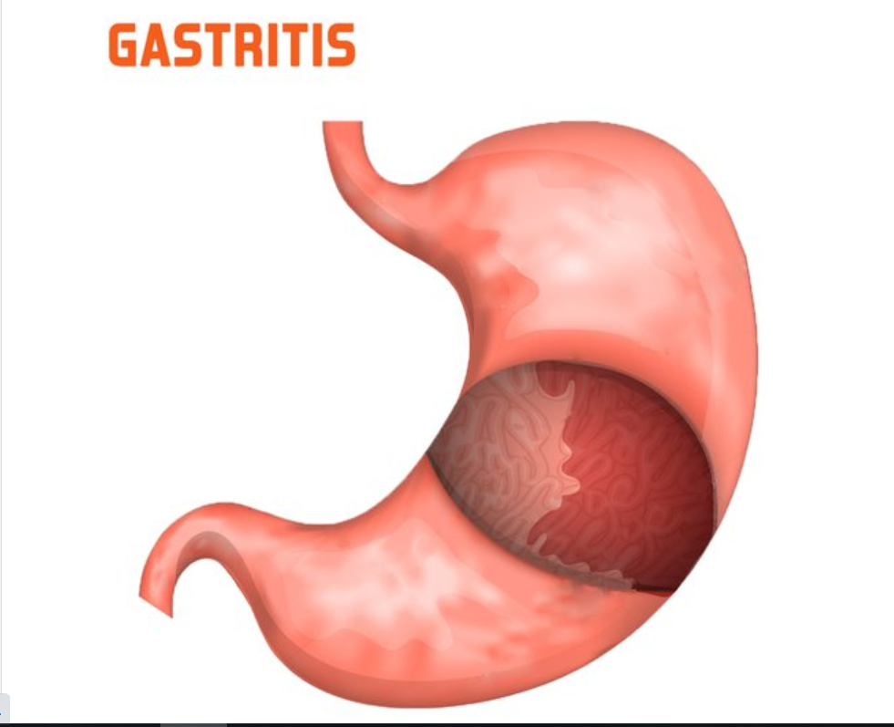 گاستریت (ورم معده)