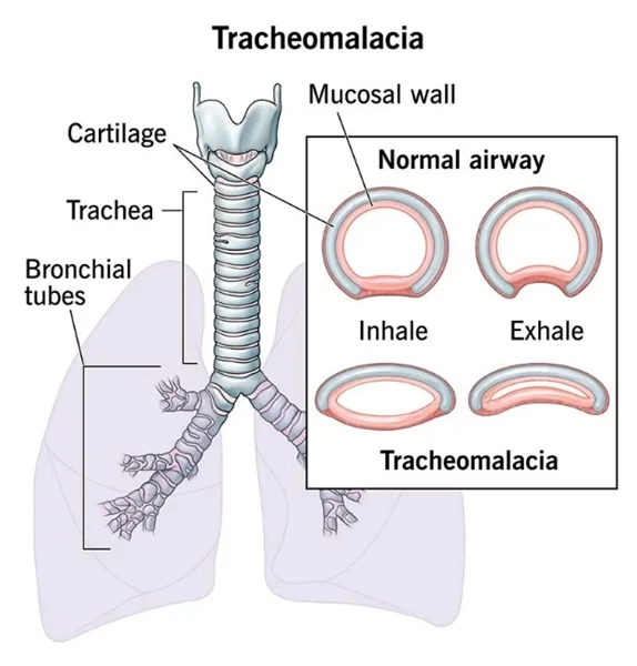 تراکئومالاسی (Tracheomalacia)