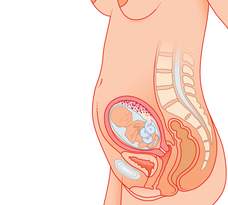 هموروئید یا بواسیر در بارداری