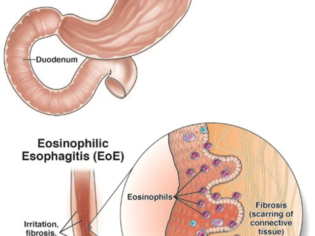 ازوفاژینت ائوزینوفیلیک (Eosinophilic Esophagitis)