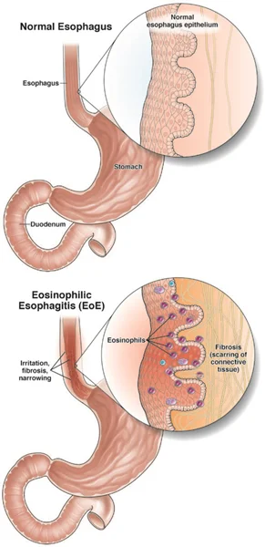 ازوفاژینت ائوزینوفیلیک (Eosinophilic Esophagitis)