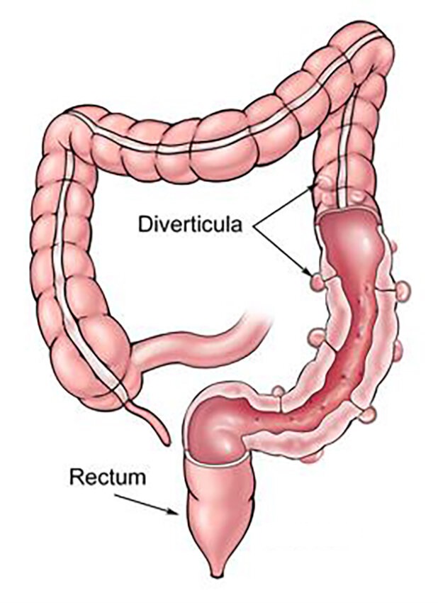 سوالات متداول در مورد بیماری دیورتیکولار